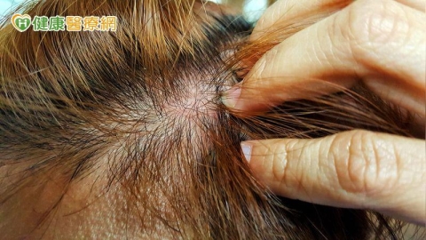 癌友頭皮長皮疹、潰瘍怎麼辦？護理師教正確照護4步驟