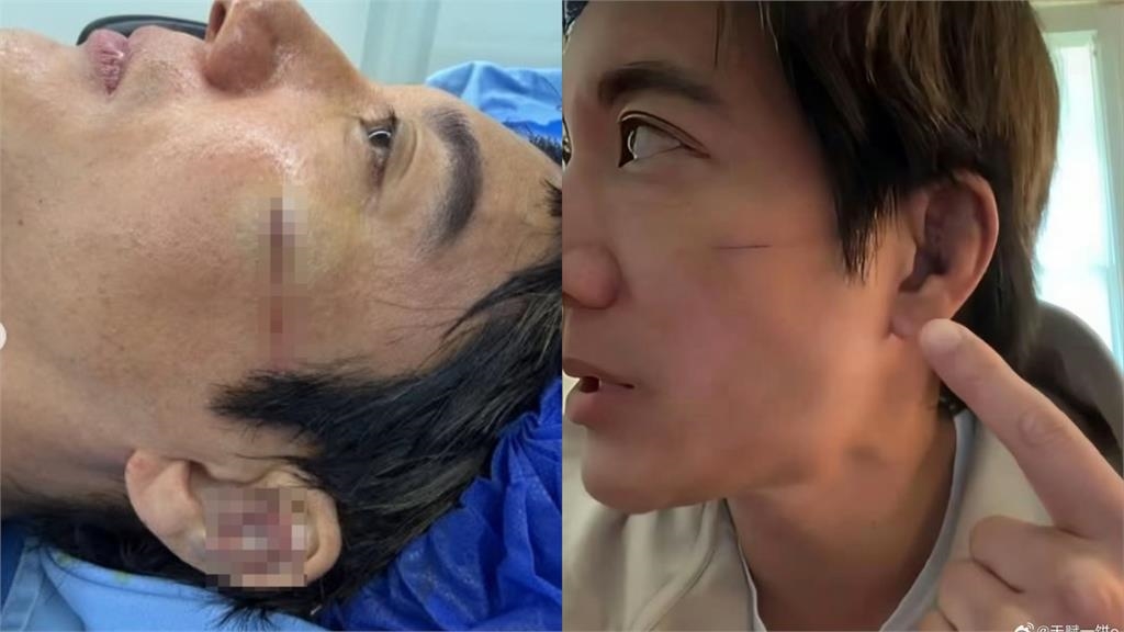 王力宏驚人傷勢曝!好友范瑋琪透露手術過程 大讚:真男人