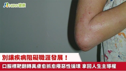 別讓疾病阻礙職涯發展!口服標靶翻轉異膚愈抓愈癢惡性循環 拿回人生主導權