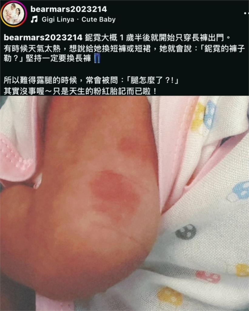 愛女堅持出門穿長褲!熊熊曬腿上粉紅胎記 遭問「怎麼了」親揭真相!