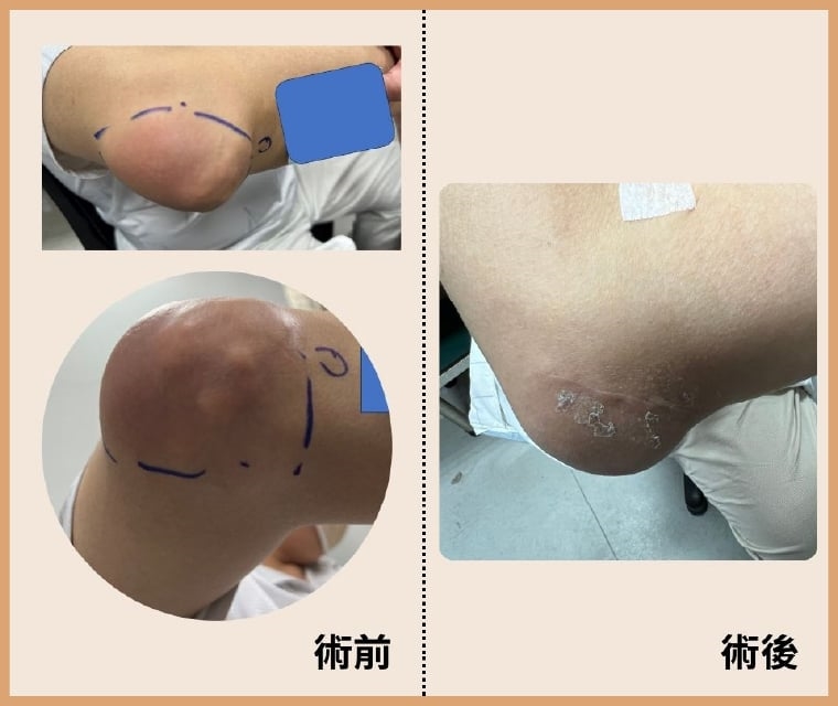 手肘痛風石像開盲盒!外觀一處腫塊 微創竟清出10多顆