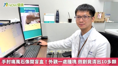 手肘痛風石像開盲盒！外觀一處腫塊 微創竟清出10多顆
