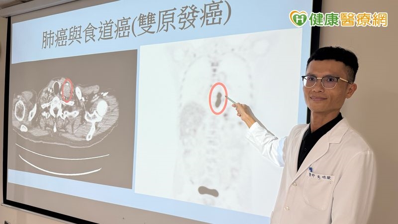 肺腺癌8年後再罹食道癌!醫揭「雙原發癌」不是癌轉移 菸酒史是關鍵