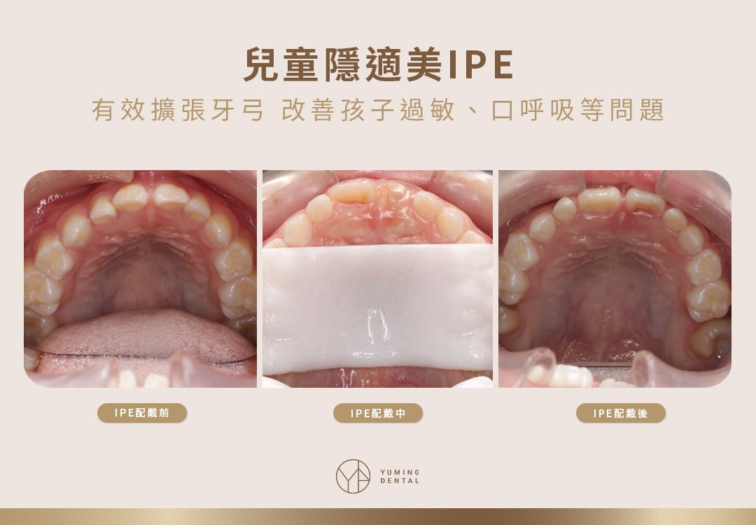 孩子鼻塞黑眼圈問題在顎骨？ 活動式牙弓擴張器助改善