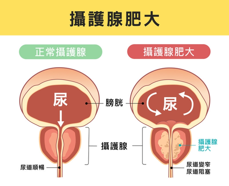 熟男夜尿頻繁當心是攝護腺肥大 醫揭「治療選擇」防尿道感染