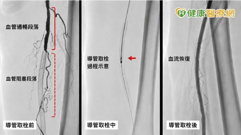 腳突然冰冷疼痛別輕忽!86歲婦人險截肢 醫揭血管急症警訊