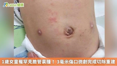 1歲女童罹罕見膽管囊腫! 3毫米傷口微創完成切除重建