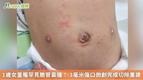 1歲女童罹罕見膽管囊腫! 3毫米傷口微創完成切除重建