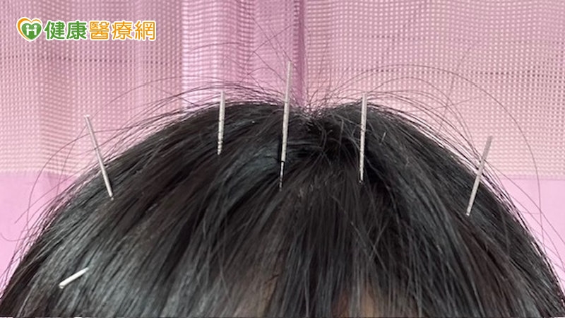 「鬼剃頭」找上門怎麼辦?醫揭中西醫治療與調理生髮對策