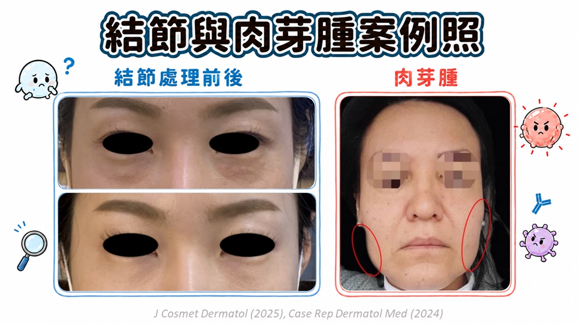 赴韓做醫美竟變「釋迦臉」!醫拆解5大微整結節成因防踩雷