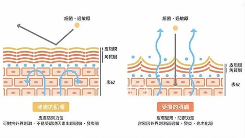肝斑雷射後又變深?從基底膜變化認識肝斑反覆與治療評估觀念