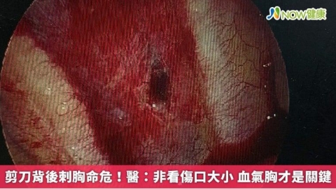 剪刀背後刺胸命危!醫:非看傷口大小 血氣胸才是關鍵