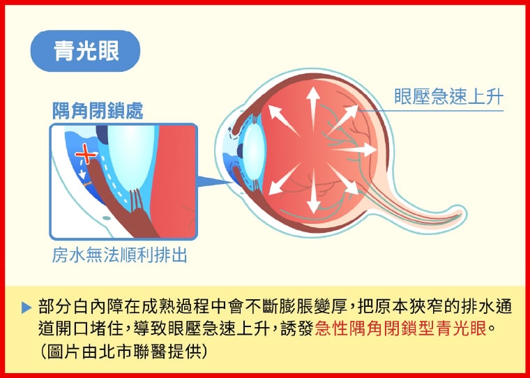 白內障別拖!水晶體變厚恐堵隅角 引發急性青光眼危機