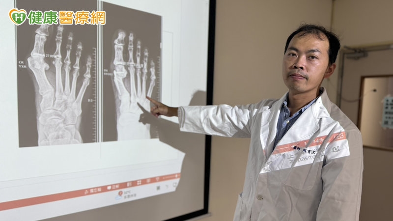 拇趾外翻近30度變回個位數！截骨矯正助重返登山活動