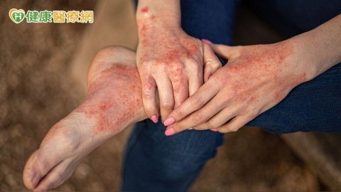 異位性皮膚炎、乾癬不只是皮膚病　反覆發炎當心影響全身健康
