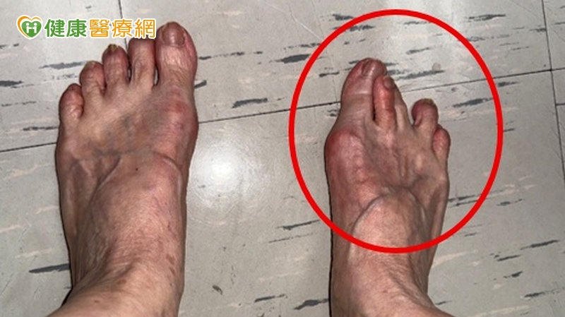 穿高跟鞋才會得「拇指外翻」？醫：扁平足與遺傳皆是高風險族群