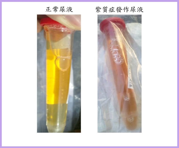 28歲女多年不明反覆腹痛! 醫揪元凶是罕病急性紫質症