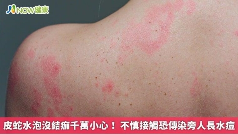 皮蛇水泡沒結痂千萬小心! 不慎接觸恐傳染旁人長水痘