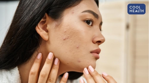 痘痘治了還是一直長？ 別急著亂換藥！ 醫：亂換藥「怎樣都會復發」