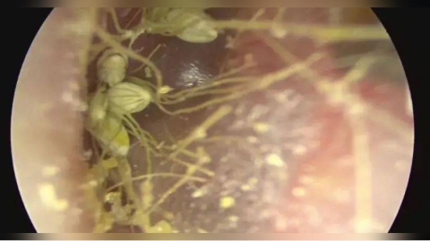 1歲童狂抓耳就診！耳道口驚見「植物種子」　醫一照驚呆：發芽了