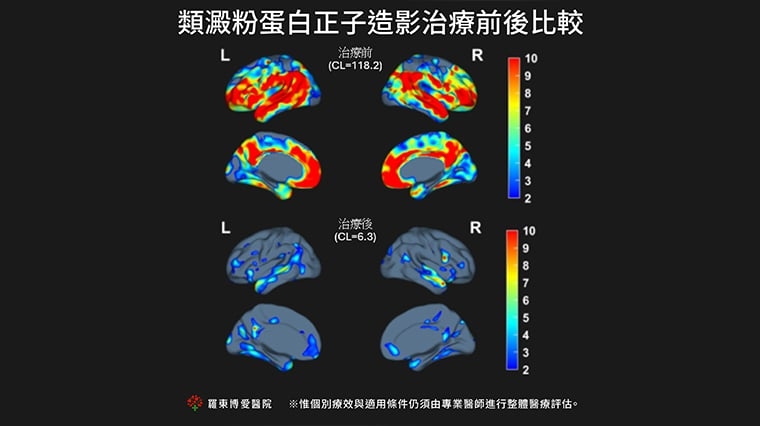 失智症治療新進展 單株抗體標靶藥延緩阿茲海默症退化