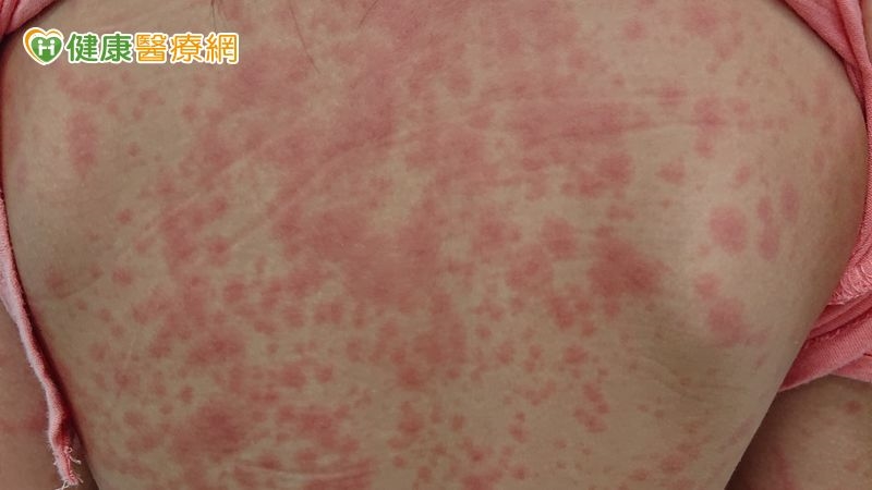 孩子反覆高燒久咳不癒全身皮疹 竟是「肺炎黴漿菌」作祟