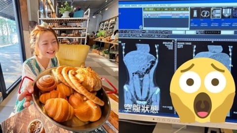食物到底去哪?大胃王小慧照CT「巨大黑洞現形」 女神嚇傻:魯夫的胃