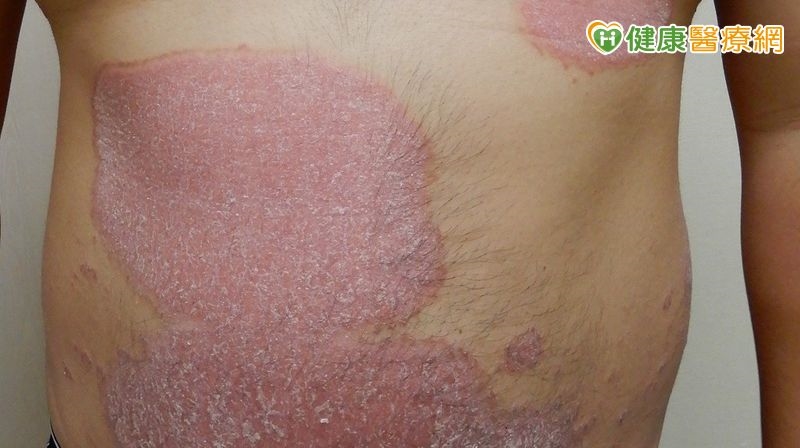50歲男皮膚過敏2年沒好!紅斑一路蔓延到指甲 就醫才知是「乾癬」