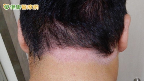 50歲男皮膚過敏2年沒好!紅斑一路蔓延到指甲 就醫才知是「乾癬」