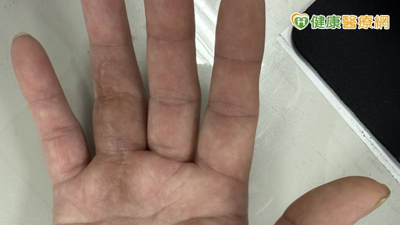 傷口只有2個針孔，手指卻彎不起來？醫師提醒：手部處置後別只看表面