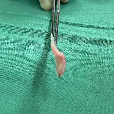 38歲男鼻塞多年!睡覺只能張口呼吸 檢查揪「2問題」堵住鼻道