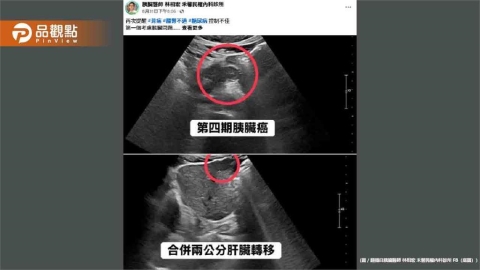 血糖失控竟是癌王警訊！50歲男確診胰臟癌四期已轉移肝臟
