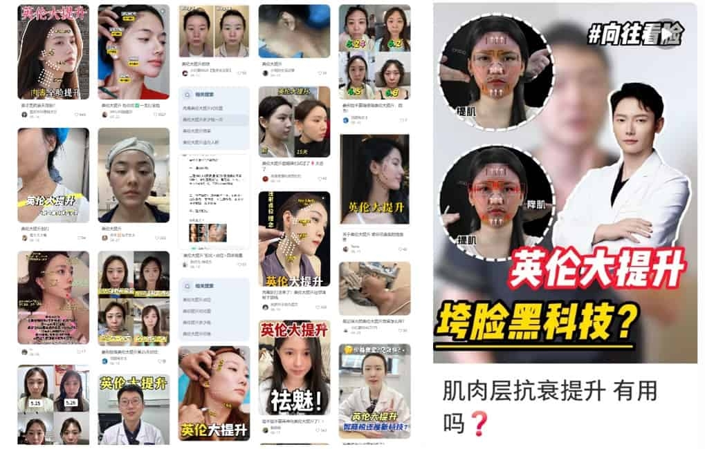圖說:楊醫師表示,英倫大提升的論述多半建立在經驗分享上,對注射的深度、層次與點位缺乏可對位的解剖依據。(圖片來源:小紅書)