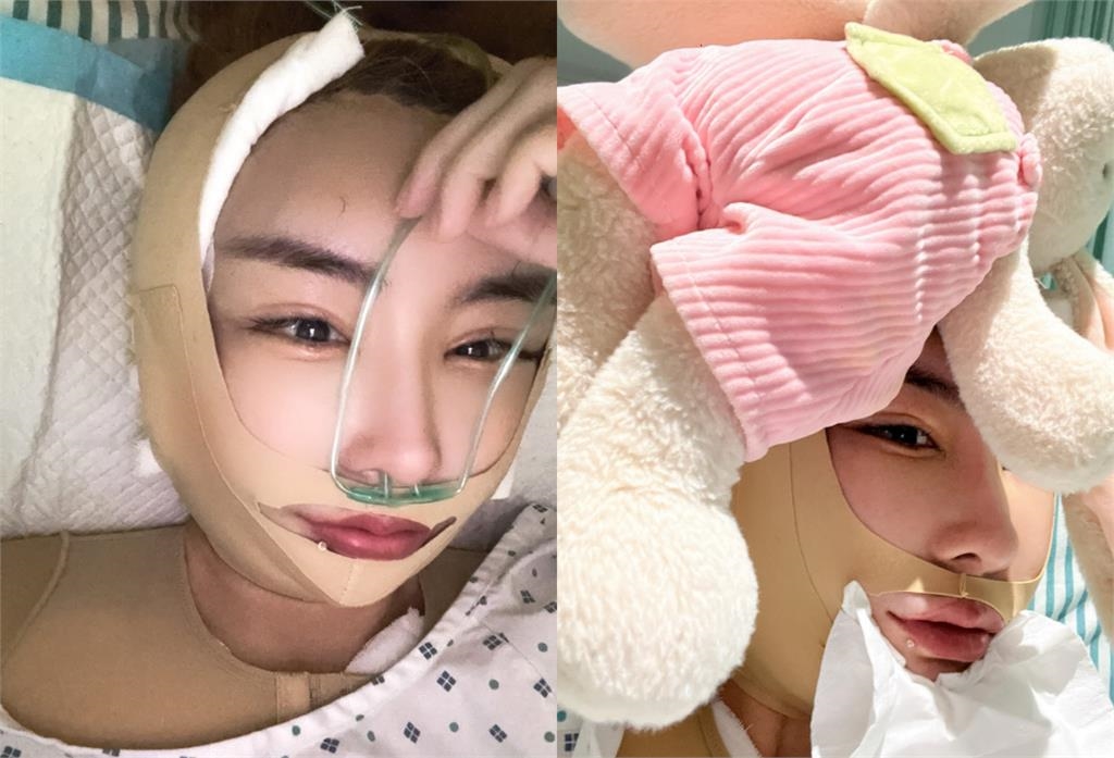 雪碧「全臉超腫」又飛上海整型!頭頂變形「拉出20多條異物」驚悚畫面曝