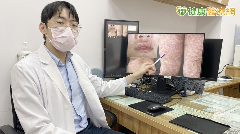 37歲女吃藥發燒出疹　檢測揪出複方藥「這成分」致敏