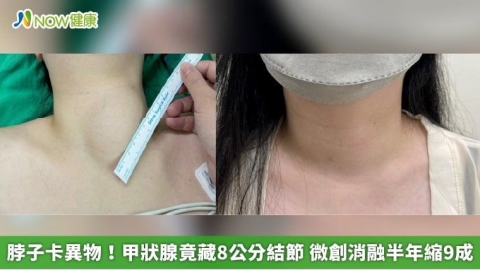 脖子卡異物!甲狀腺竟藏8公分結節 微創消融半年縮9成