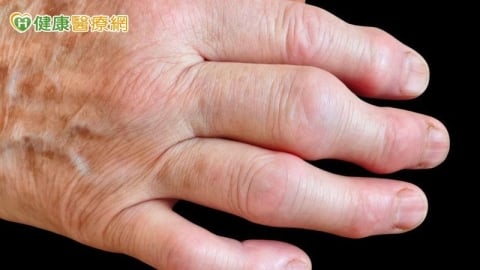 類風濕性關節炎造成手指腫痛變形 「 微細動脈栓塞 」介入可緩疼痛