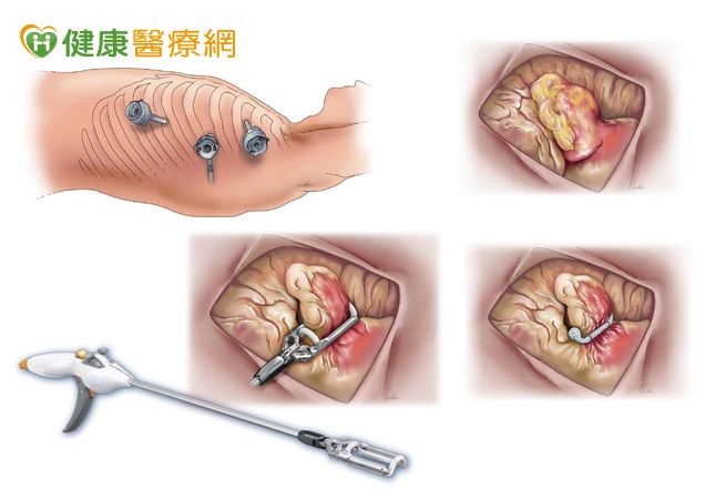 心房顫動無法持續用藥陷中風危機!醫評估「這項手術」另一選擇