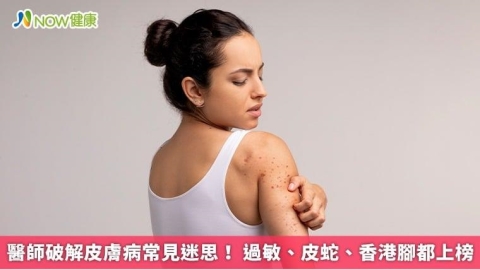 醫師破解皮膚病常見迷思! 過敏、皮蛇、香港腳都上榜