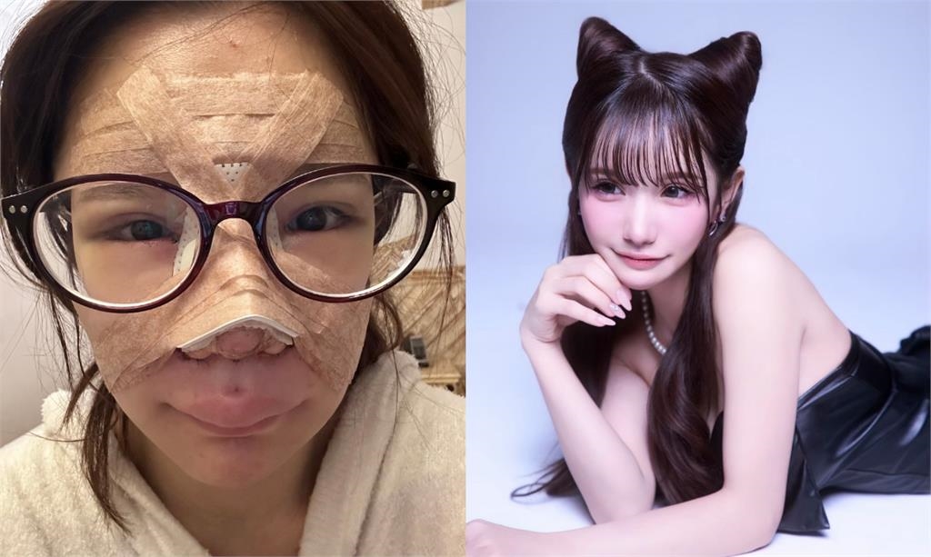 暴牙妹子「砸554萬全臉暴改」走紅!震撼宣布「參演Netflix」絕美近照被挖