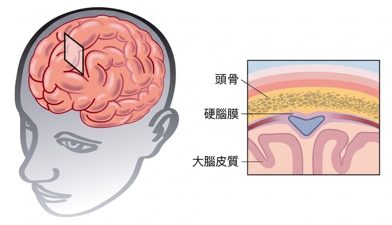 「腦機介面」是什麼?大腦一動就能控制機器?智慧醫療新趨勢一次掌握!