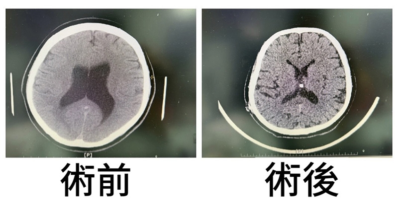 長者走路像「黏在地上」還尿失禁　小心「交通性水腦症」作祟 