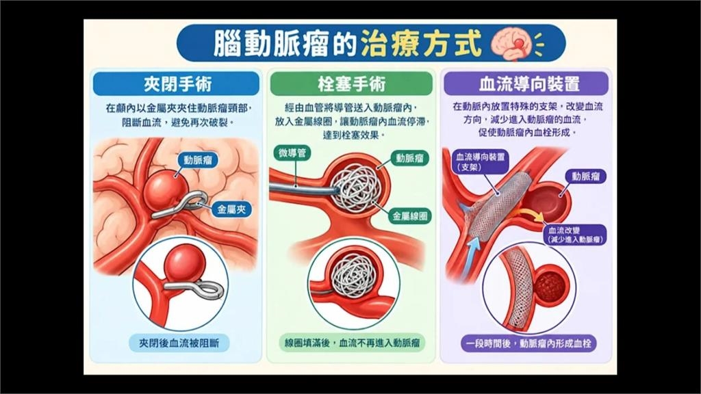 香港旅客劇烈頭痛昏厥 竟是腦動脈破裂 在台緊急手術!