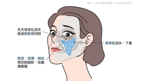 淚溝、太陽穴凹陷怎麼評估?認識玻尿酸與不同注射材質的特性