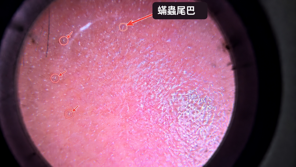 圖說:皮膚鏡下可見毛孔開口處細細白白的絲狀結構,為常見的「蠕形蟎尾巴」表現;是否需要治療,仍須配合皮膚症狀與專業檢查綜合判斷。