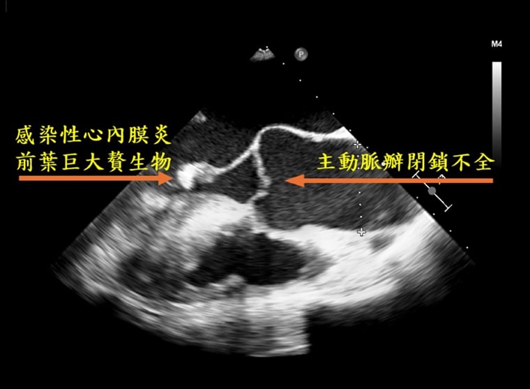 ▲經食道心臟超音波影像,標示處可見主動脈瓣膜閉鎖不全,及因心內膜炎造成的贅生物。(圖/台北慈濟醫院提供)