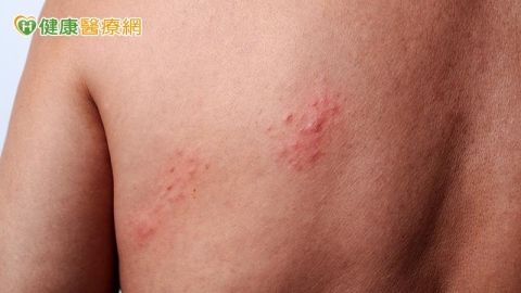皮膚病一定能「斷根」?醫破解過敏、香港腳與帶狀皰疹常見迷思