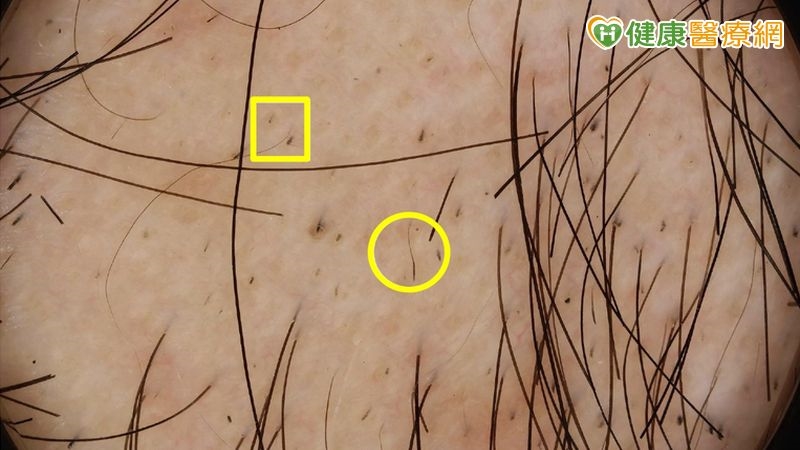 ▲毛髮鏡檢查可見圓形禿特徵,包括斷髮黑點(方框處)、驚嘆號髮(圓圈處)。