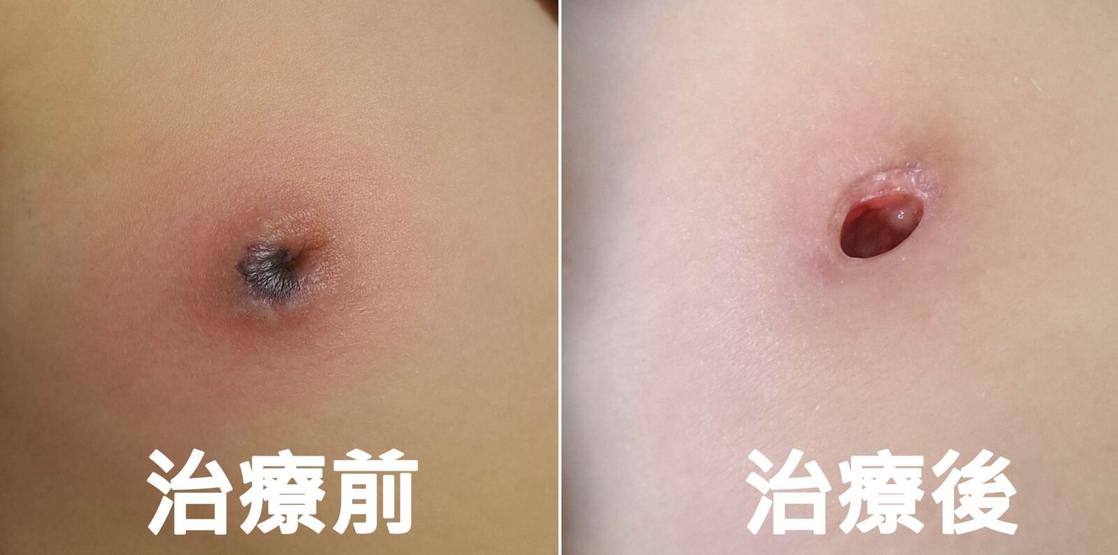 小一女童傷口感染綠膿桿菌 乳頭「幾乎被吃光」! 4 小一女童傷口感染綠膿桿菌 乳頭「幾乎被吃光」! 3