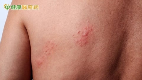 皮膚病一定能「斷根」?醫破解過敏、香港腳與帶狀皰疹常見迷思
